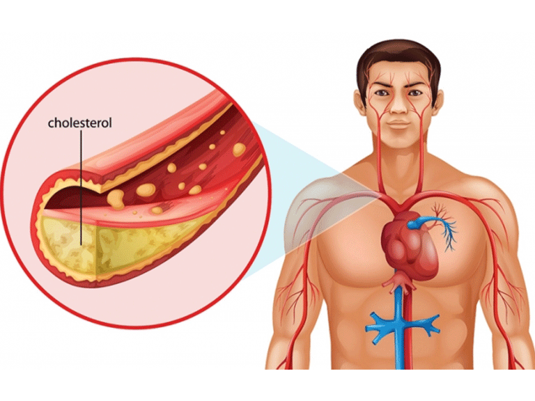 علائم چربی خون بال