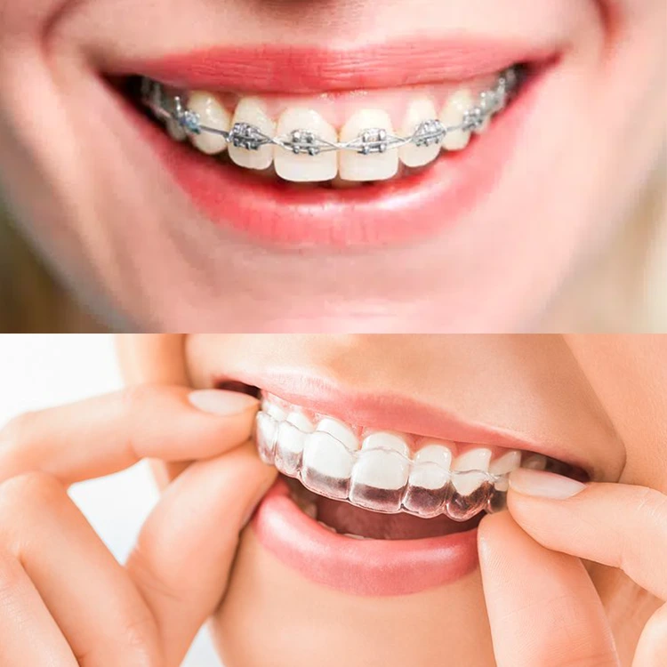 بهترین روش ارتودنسی در بارداری