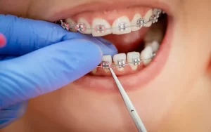 مراقبت های هفته اول ارتودنسی