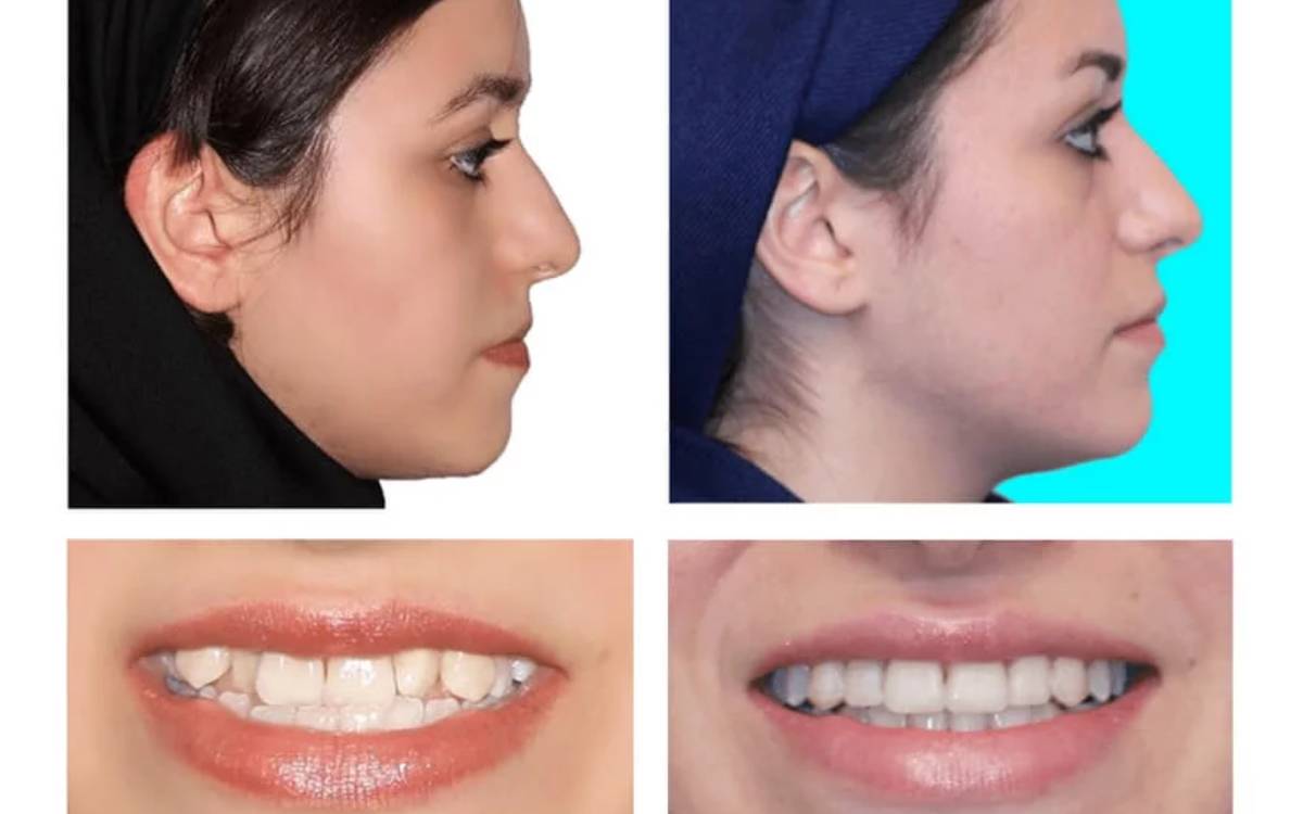 تغییر چهره بعد از ارتودنسی