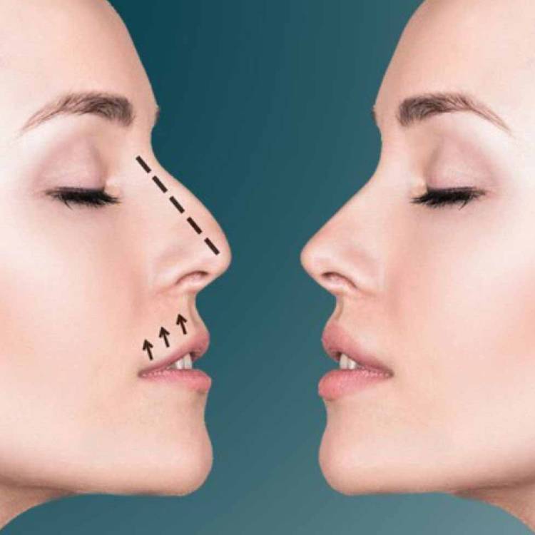 تغییرات فرم بینی با ارتودنسی 