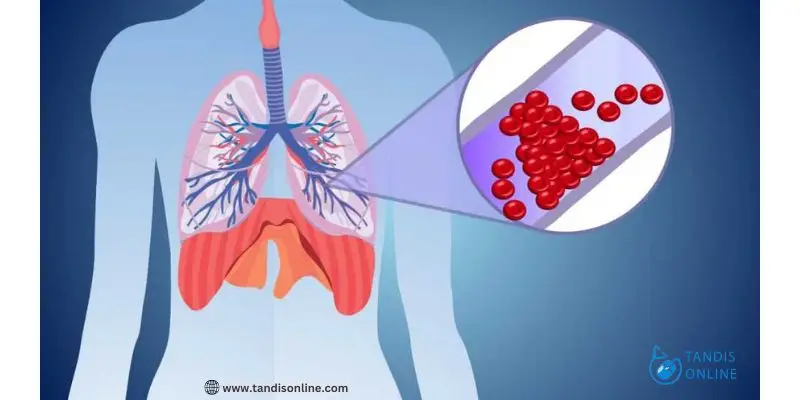 علت آمبولی ریه